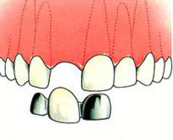 Composiet vulling nadelen Composiet vulling nadelen